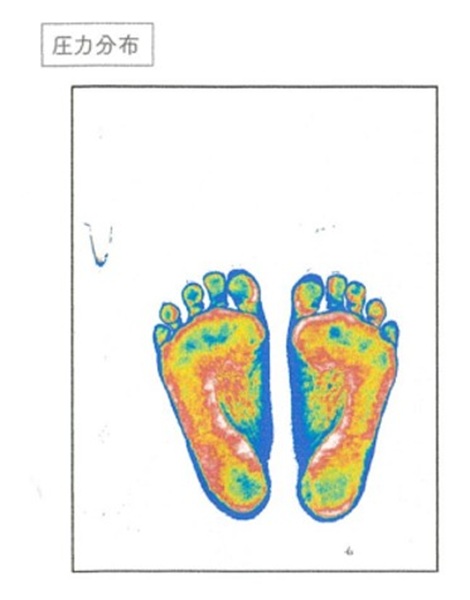 ひざが影響? 「土踏まず」が消えた衝撃