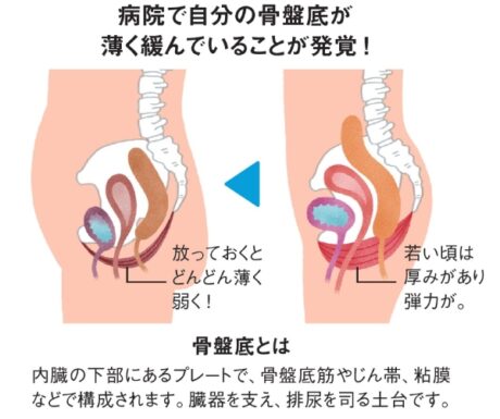 尿漏れは「命と直結している」筋肉の衰え。放置しないで