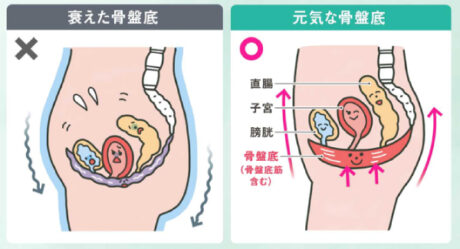 くしゃみの拍子に「ドキッ」! 骨盤底の衰えが一因です